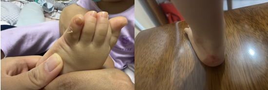 千元童鞋把脚穿肿？泰兰尼斯遭家长“围攻”，医生警惕影响发育，90%专利竟是外观设计  第3张